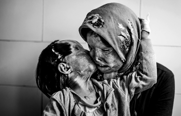 acid-attack-on-mother-and-child